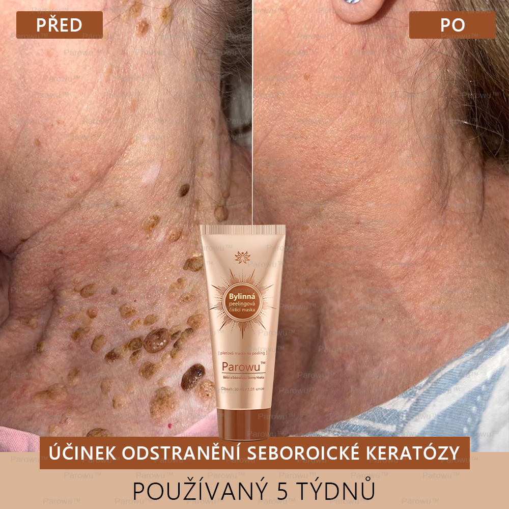 💟💟 Parowu™ Bělící a Odstraňující Skvrny Maska -🍀Přírodní složky trvale odstraňují pigmentové skvrny, stařecké skvrny, pihy a sluneční skvrny